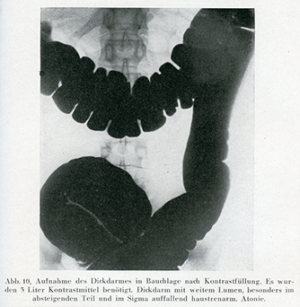 Röntgenaufnahme des Dickdarms 